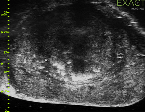 ExactVu Micro-ultrasound image