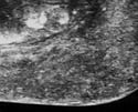 ExactVu Micro-ultrasound zoomed image