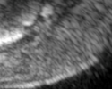 Ultrasound zoom image