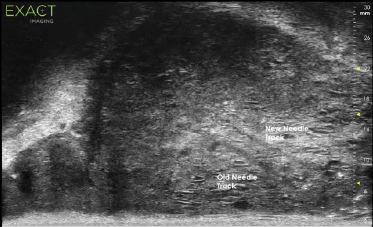 Detection and targeting of small Gleason 8 Lesion.