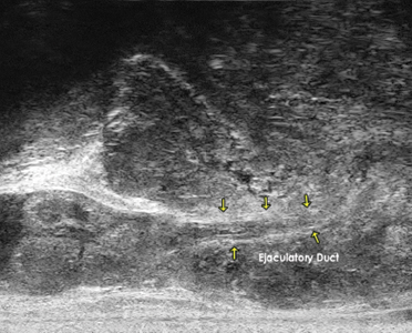 Fluid flowing through Ejaculatory Duct.