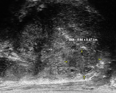 Detection and targeting of small Gleason 8 Lesion.